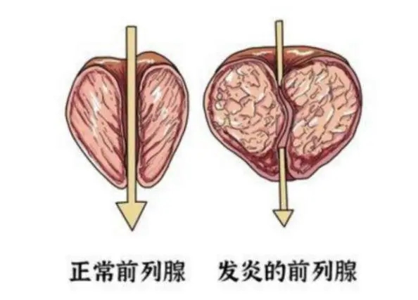 增生肥大1